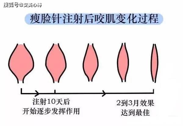 打瘦脸针失败怎么办