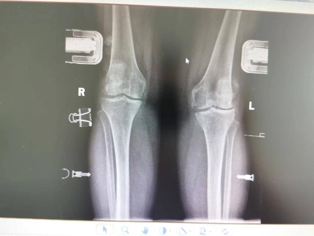 膝关节置换医院排名_膝关节置换图片(2)