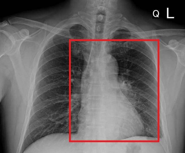 ▼医师照x光发现男子肺部有颗7*5公分大的肿瘤,已经是肺癌末期.