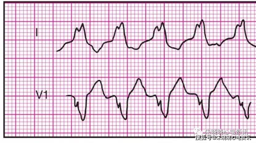 常见的14种异常心电图的波形特点建议收藏
