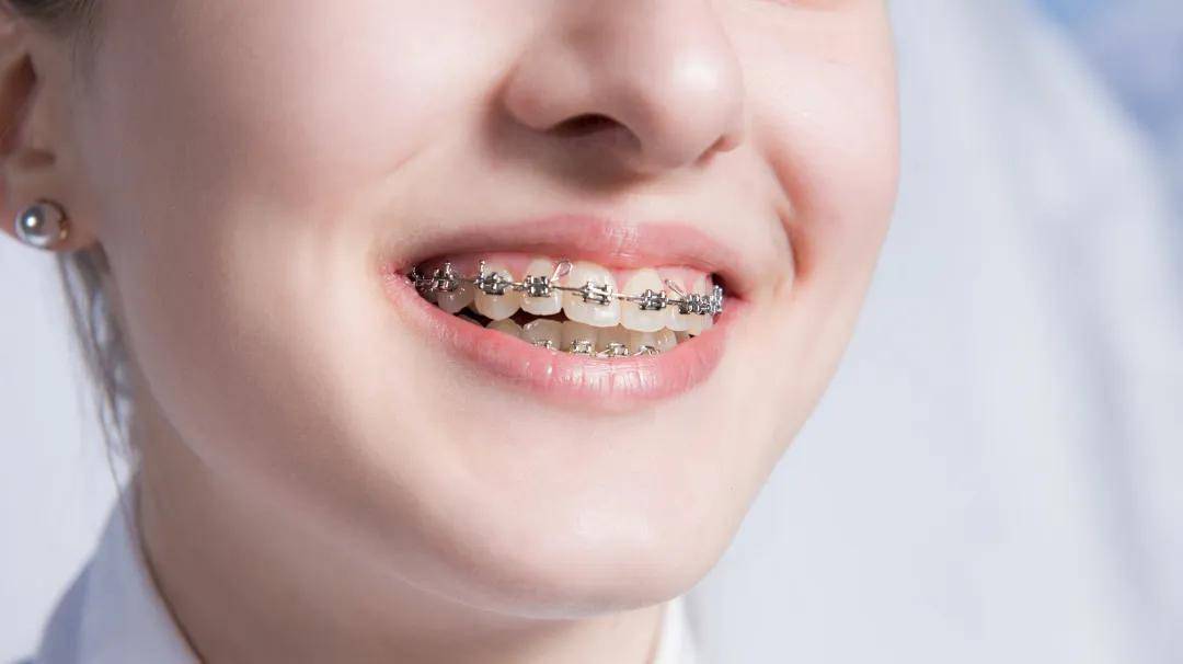 箍牙能瘦脸吗?来看华西口腔专家的6个箍牙提醒!