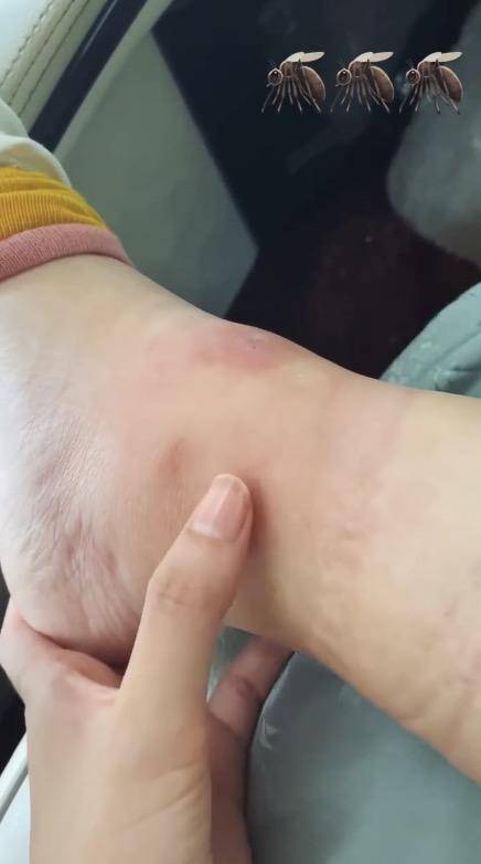 脚踝|乔欣象山拍戏被毒蚊子攻击，脚踝肿胀离谱，一按一个坑太夸张