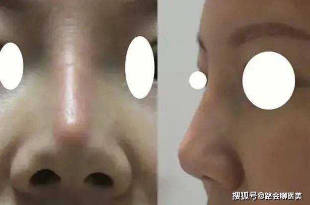 怎样才能让鼻梁高一些 fe18f7cdf05948049f83a01dd3f39c17.jpeg