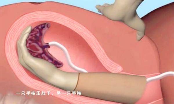 原创孩子娩出后，为什么胎盘却排不出？3个原因只有经历过的产妇清楚