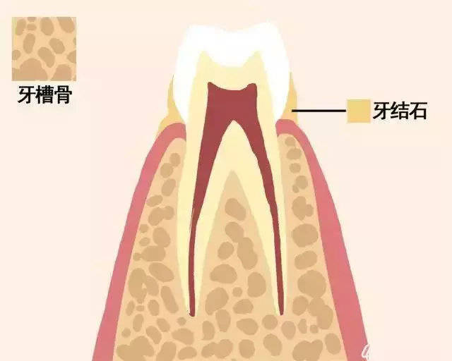 2当牙龈上部有牙结石和菌斑,但牙周组织还没有被破坏,所以牙齿还是