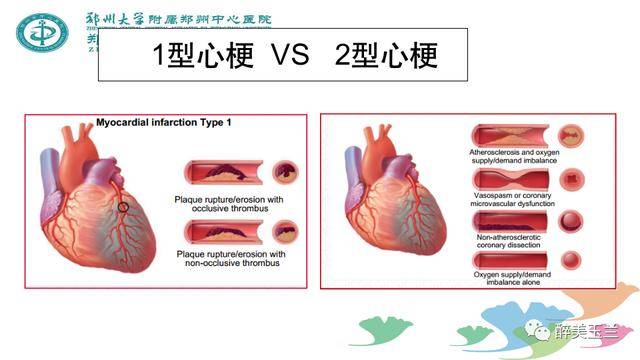 围术期急性心肌梗死患者的麻醉管理