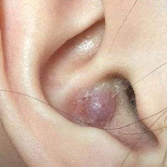 北京玉泉医院耳鼻喉科:夏季注意耳内长这种痘痘._外耳