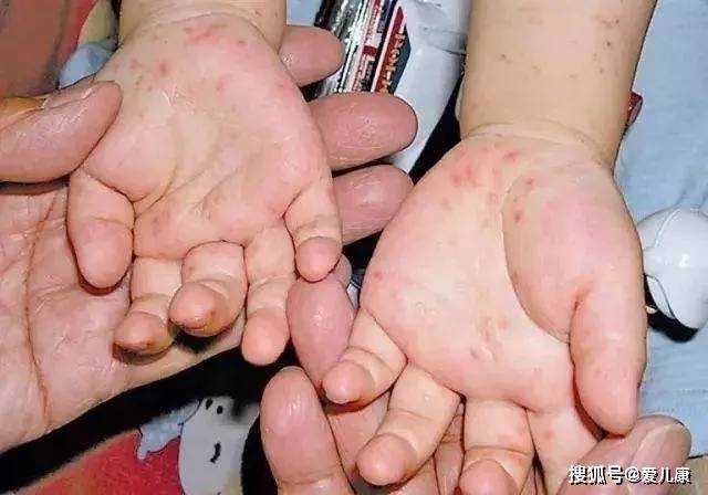 又一个传染极强的病毒正高发！家有5岁以下儿童注意了…