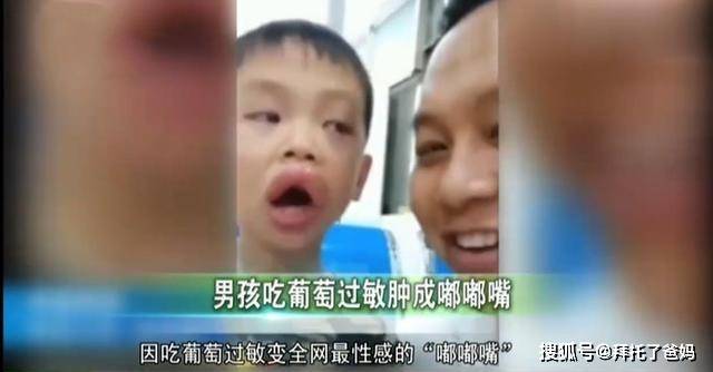 原创男孩吃完葡萄过敏肿成“嘟嘟嘴”，送医院后爸爸反应亮了！