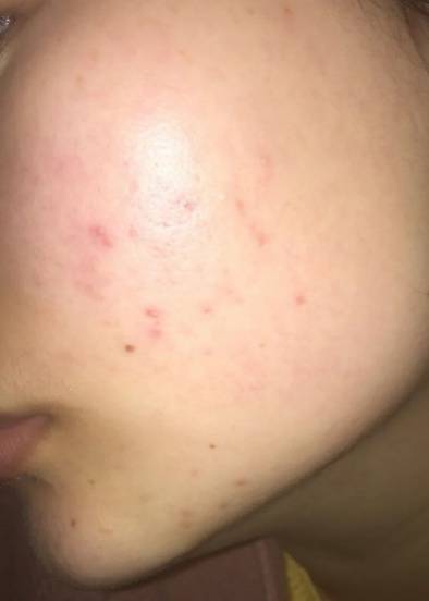 你有没有相见恨晚的祛痘方法?