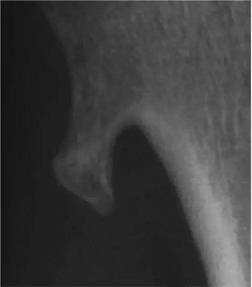 x线入门几种骨肿瘤及肿瘤样病变的x线平片表现