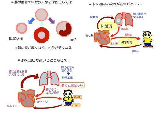 凶险的"蓝嘴唇":关于肺动脉高压,你应该知道的