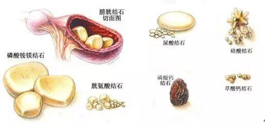 种常见的泌尿结石,患者通常会有不同程度的疼痛,血尿,尿路感染等症状