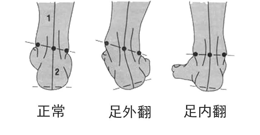 作用:髋关节外旋肌群过紧,内收内旋肌群无力,导致股骨过度外旋, 通过