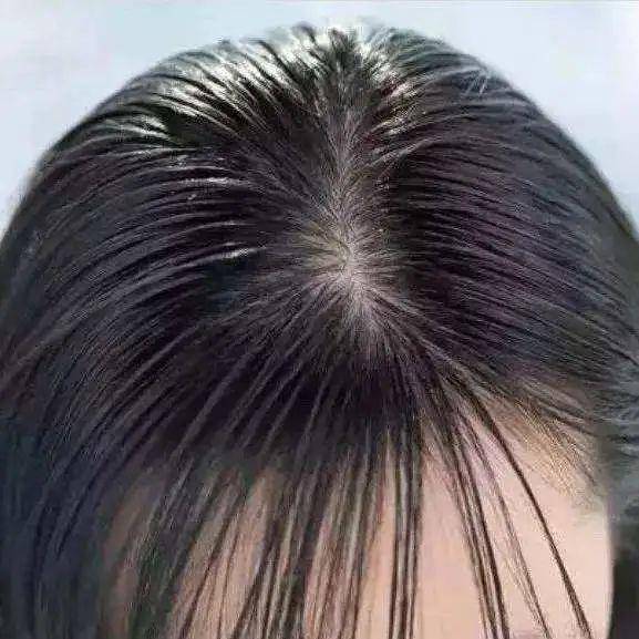 人间|叹头部SPA!拒做人间“油”物,解锁防秃养发小妙招!