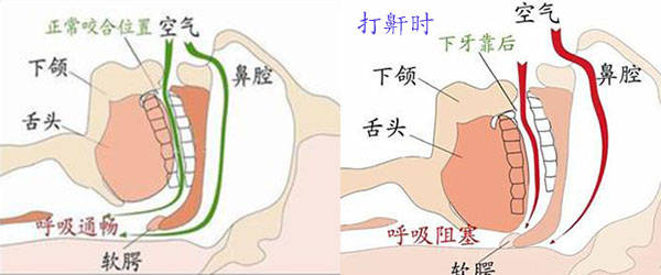 导致打呼噜(打鼾)原因