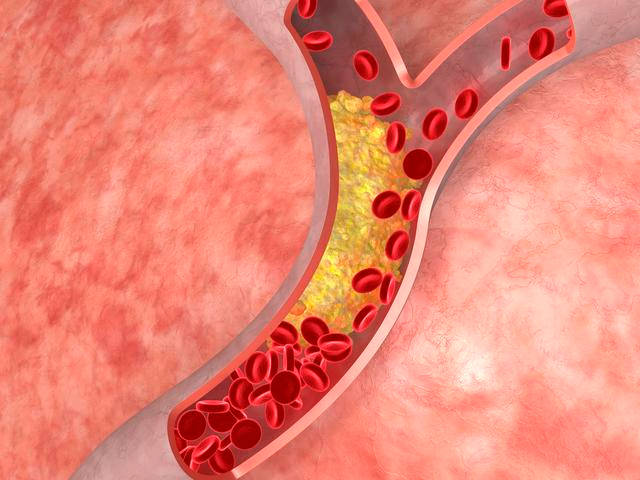 胆固醇为什么会导致心脑血管疾病,高血脂的你一定要清楚这个问题_手机