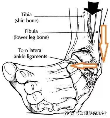 外侧有三条强壮的橡皮筋(外侧韧带)将我们脚踝骨头互相绑紧,当受到