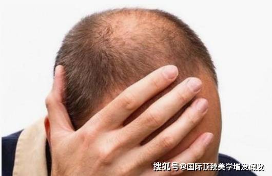 怎么才能不掉头发男生 1210a4fa0ffa4bdbbcd4a46be3dbe6e9.jpeg