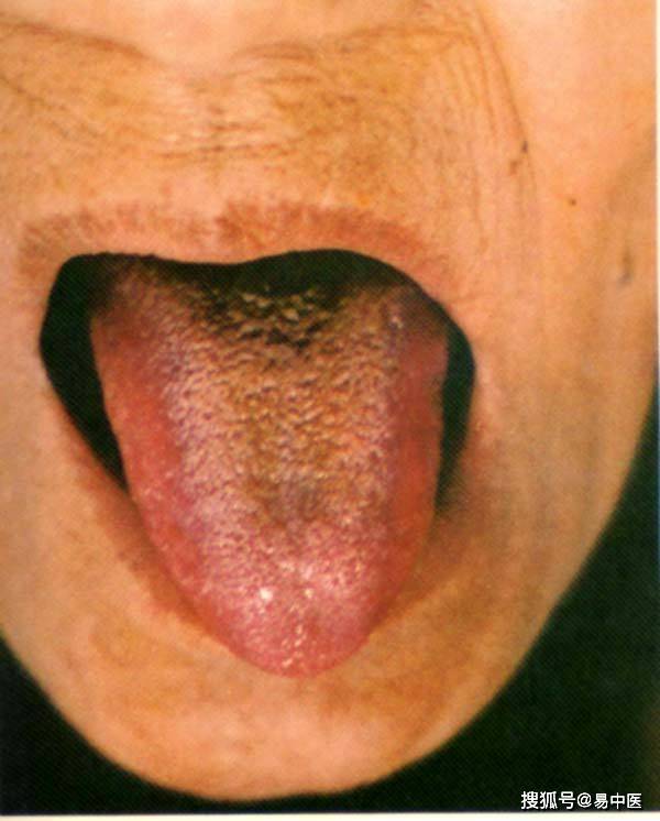 易中医:舌苔发黑反映出哪些问题?大小问题现在了解也不晚!