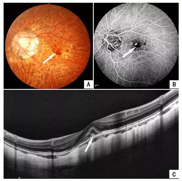 近圆形微隆起斑,四周可有出血,是从裂纹处长入了脉络膜新生血管(cnv)