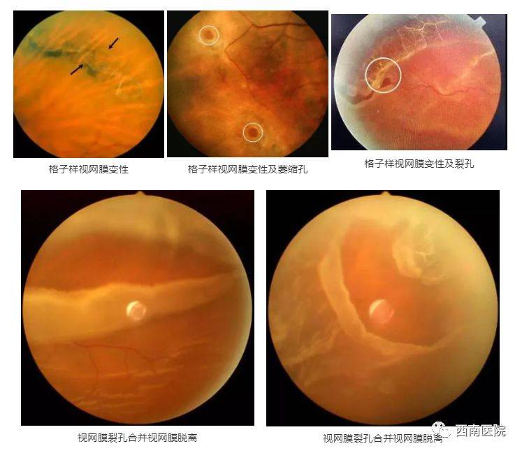 发现视网膜格子样变性区及干孔,应及时行视网膜激光治疗.