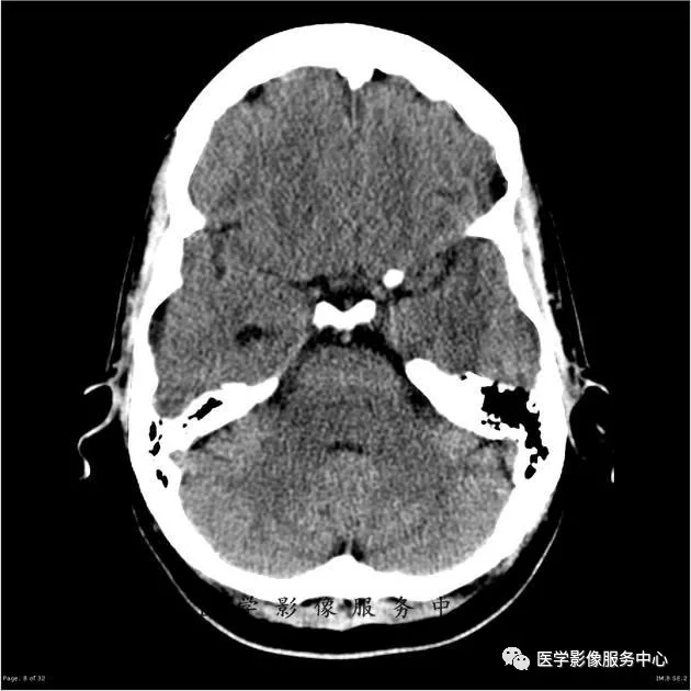 这例头颅ct片中,你能找到病变吗#医学影像病例
