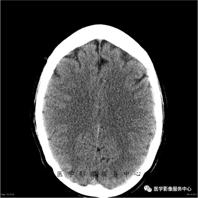 这例头颅ct片中,你能找到病变吗?#医学影像病例