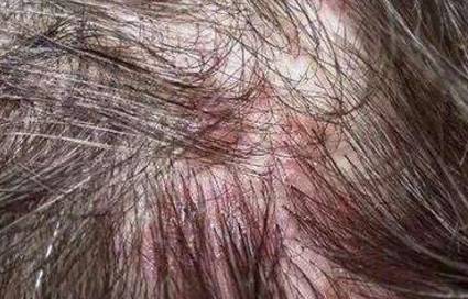 自己怎么做头皮滋养 4b1dd301680349a2a4908dc9ac0776a1.jpeg