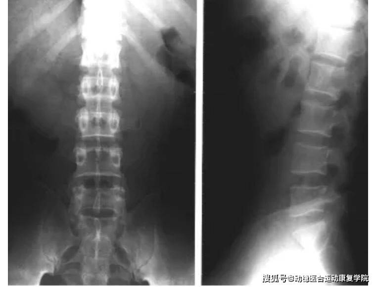 强直性脊柱炎的影像学表现及训练方法