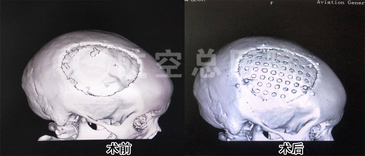 术后ct三维重建显示颅骨解剖复位良好