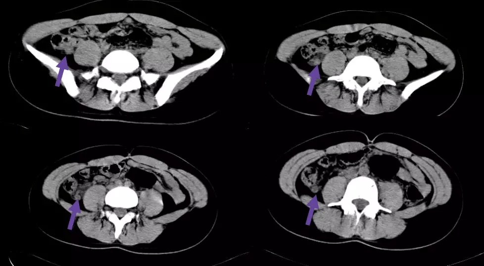 ct 片上总是找不到阑尾?3 步法教你快速定位