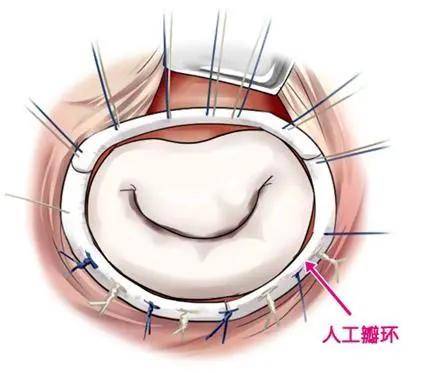 赣州首例赣州市立医院心胸外科成功完成一例全胸腔镜下二尖瓣成形术