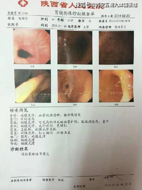 患者10:陈** 疗前胃镜为"胃窦部多发浅溃疡,慢性萎缩性胃炎",疗后为"
