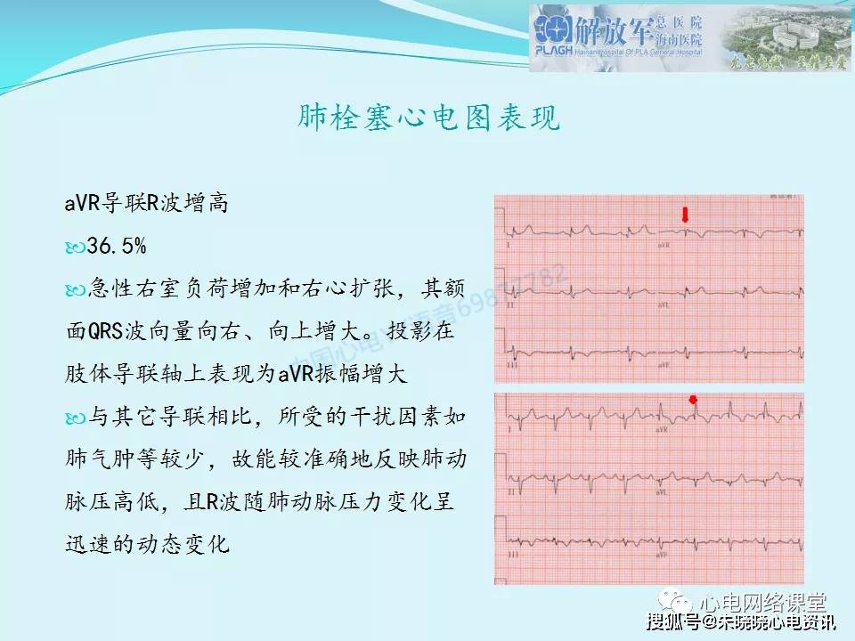 肺栓塞心电图表现及鉴别诊断