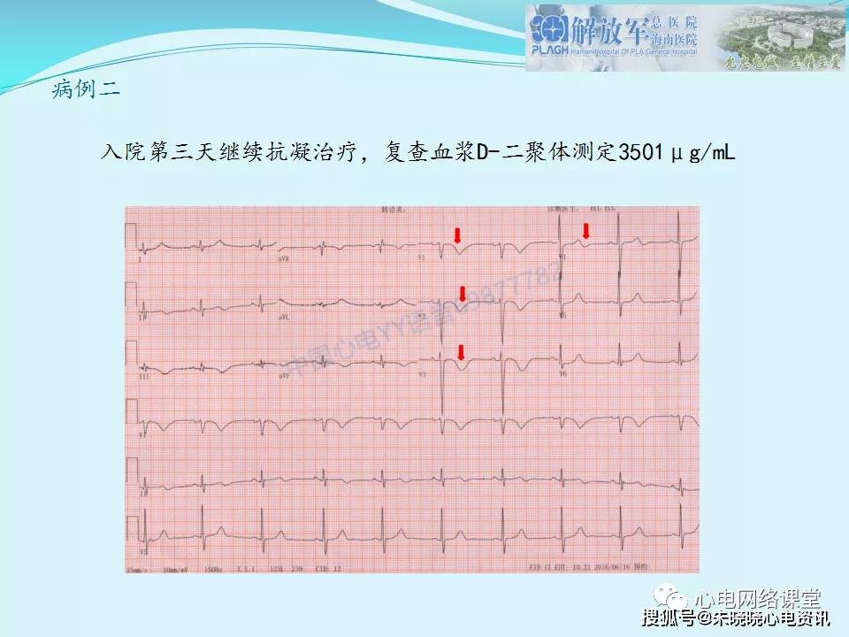 肺栓塞心电图表现及鉴别诊断