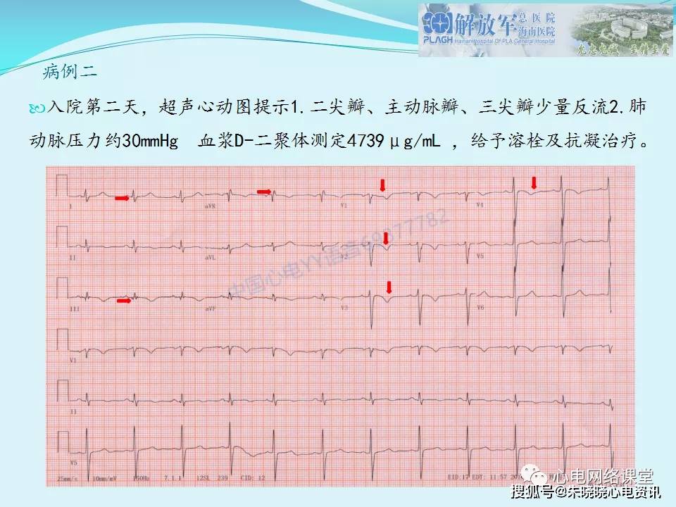 肺栓塞心电图表现及鉴别诊断