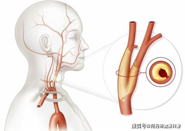 脑梗塞是什么系统 a12df2a6dd4a4f38ae5450863ce07ece.jpeg