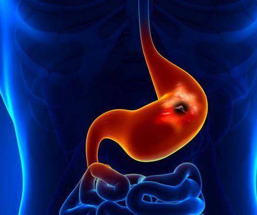 胃溃疡是什么原因？吃什么食物好？