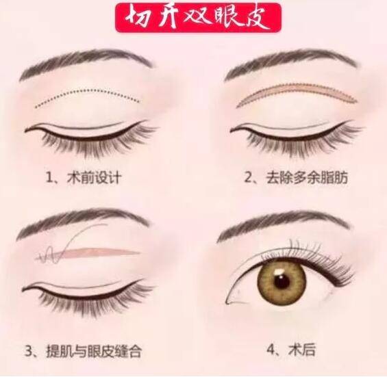 怎么让自己的眼睛不肿 7b684f74aa534c51b356ec0b85f4d489.jpeg