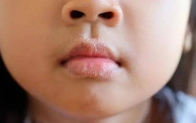 宝宝|快速Get!——湘曦源解决宝宝秋季上火小妙招