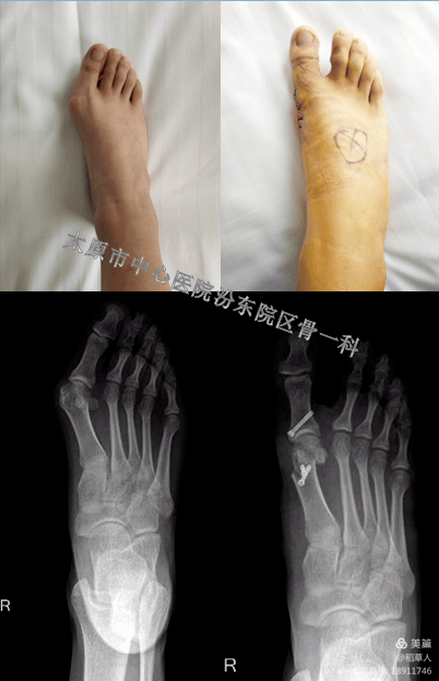 手臂外翻是什么样的 24a27aba78d947c1a6a8643286f9e73a.png