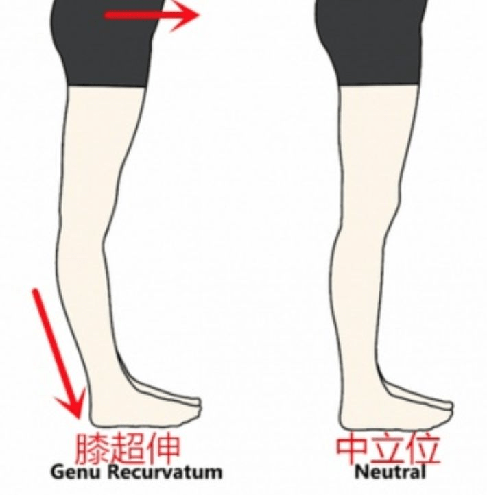 wildfieldhealth 荒野健康:xo型腿如何靠按摩或锻炼矫正?_姿势