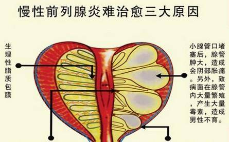 什么原因导致前列腺炎 b68750a05e7044dcba36c84f3e53ef51.jpeg