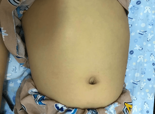 小黄人|差点急性肝衰竭，外公：一天一杯酒8岁男孩突然变成“小黄人”