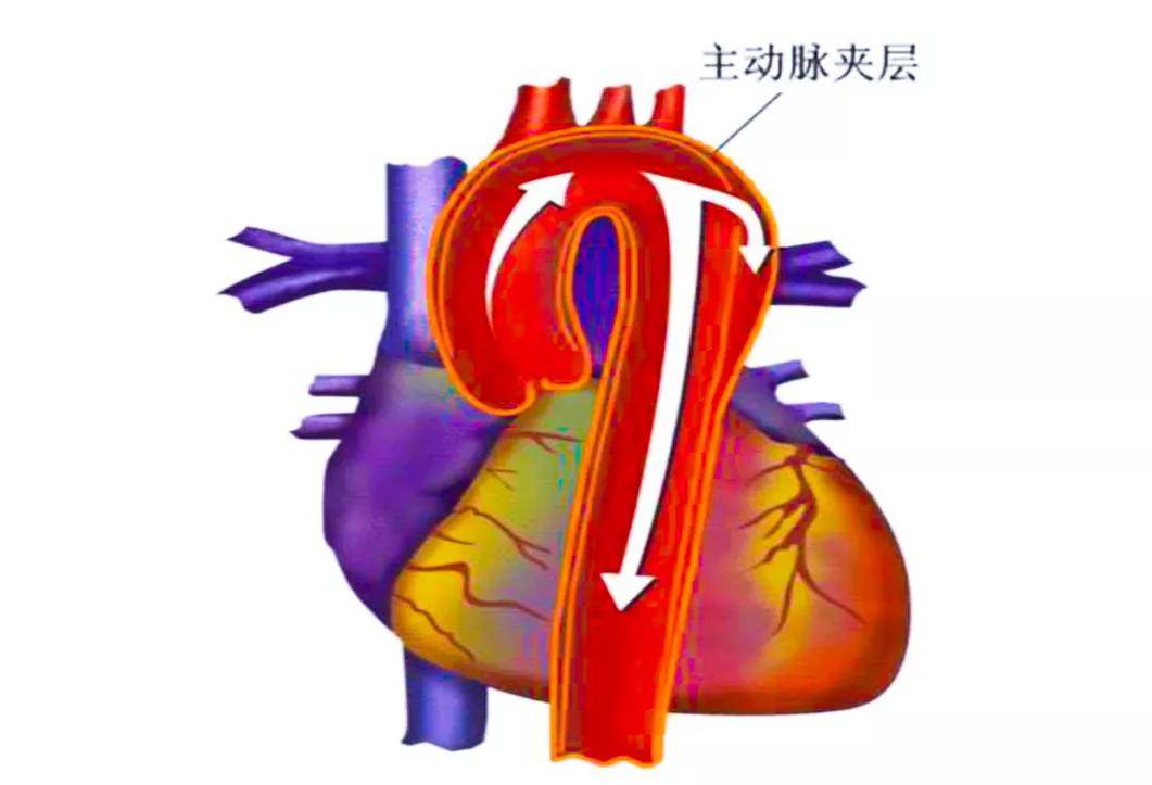 集美健康 | "主动脉夹层"心血管疾病的"王牌炸弹"