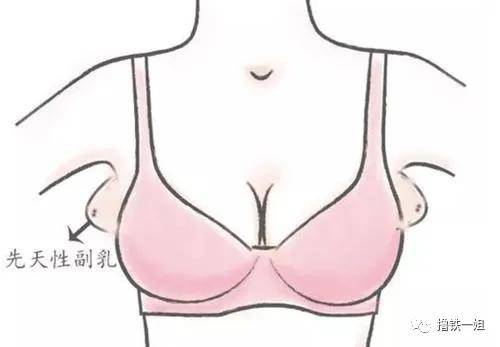 先天型副乳属于真副乳,因为它真的包含乳头或者乳腺组织.