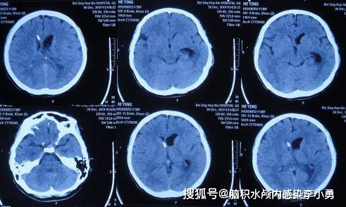 38岁女性脑出血2次双侧脑室外引流术后并发脑积水颅内感染,现在一切正常