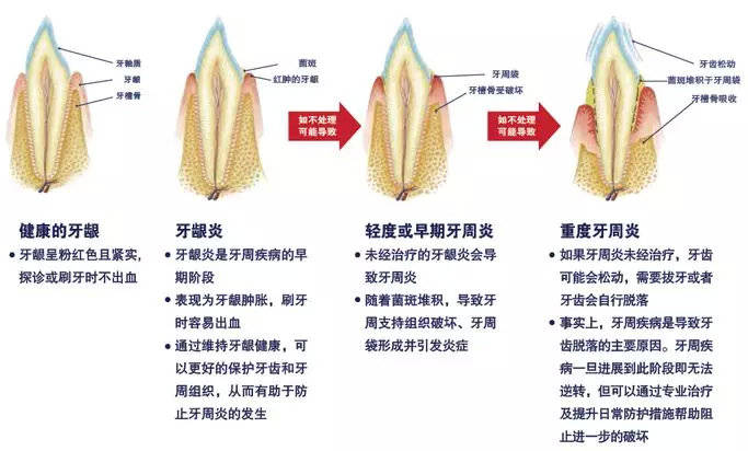 牙周炎可能导致老年痴呆症所以看牙别再拖延了