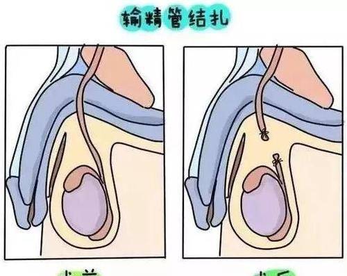 带节育环不怀孕是什么原理_节育环带在什么位置(3)